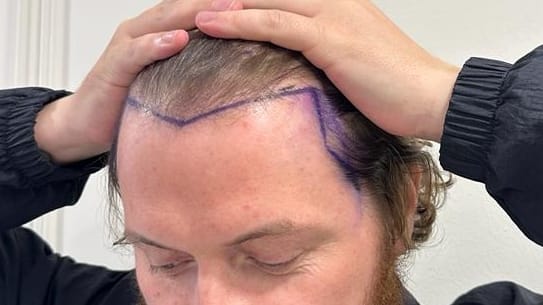 Modern Developments in Hair Restoration