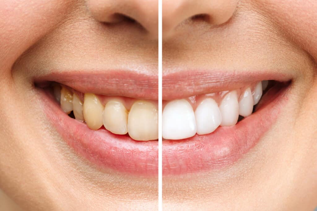 Professional Teeth Whitening vs. At-home Methods